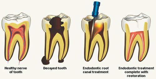 ENDODONTIC Dentistry